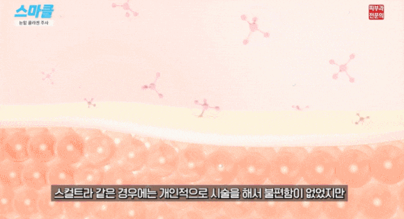 Under-Eye Hollowing Collagen Injections? We’ll Answer All Your Questions. <feat. Sculptra, Rituo, Rejuran> image 5