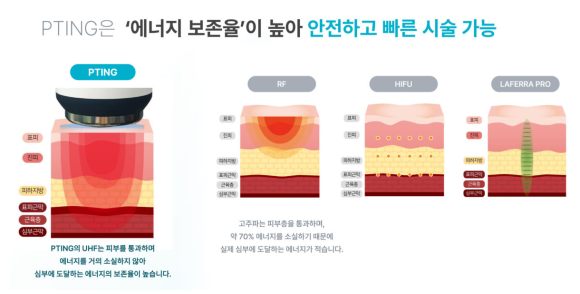 통증 없이 턱선 찾는 방법? PTING(피팅) 리프팅의 원리와 효과 관련 이미지 3