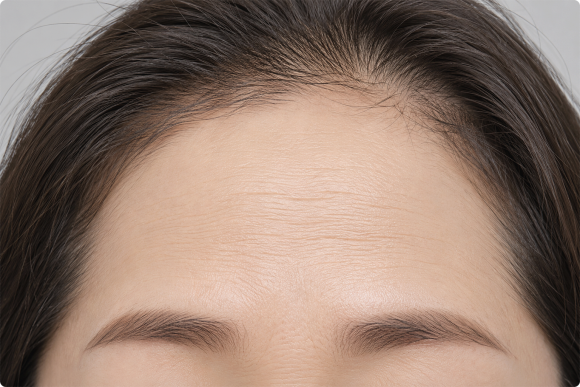 눈썹, 이마 처짐? 웰스피부과 특화 시술 <엠페이스, 아이써마지, 스컬트라> 관련 이미지 2