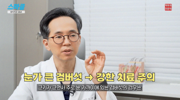 잡티 치료? 색소병변 기미, 검버섯 레이저 시술 및 관리법 (FAQ) 관련 이미지 9