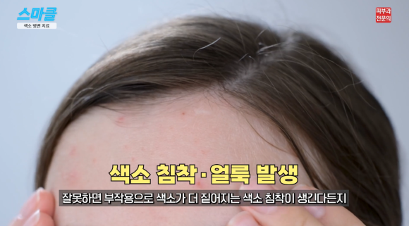 주근깨, 기미, 흑자 색소치료는 이렇게 받아야 합니다. <피부과 전문의> 관련 이미지 5