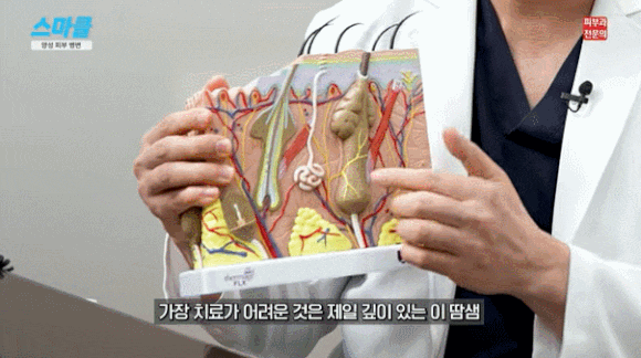 얼굴에 오돌토돌 올라오는 것, 다 같은 게 아닙니다 <한관종, 비립종, 피지증식증, 편평사마귀> 관련 이미지 5