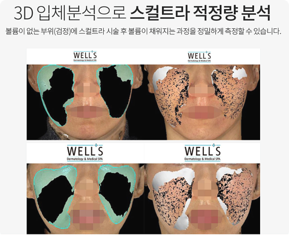스컬트라 결절, 23년 노하우로 걱정을 줄여드립니다. <피부과 전문의> 관련 이미지 7