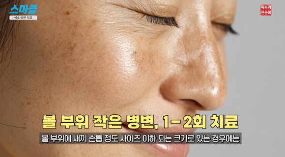 주근깨, 기미, 흑자 색소치료는 이렇게 받아야 합니다. <피부과 전문의> 관련 이미지 7