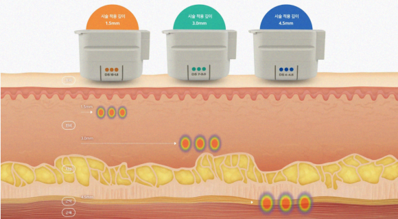 울쎄라프라임핏? 울쎄라와 피팅 리프팅, 같이 받으면 더 좋습니다. <시너지 조합 공개> 관련 이미지 5