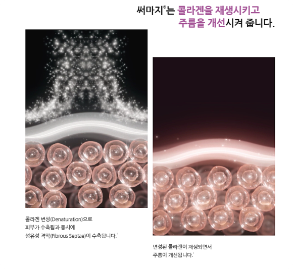 눈썹, 이마 처짐? 웰스피부과 특화 시술 <엠페이스, 아이써마지, 스컬트라> 관련 이미지 4