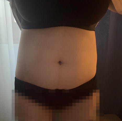 복부지방흡입 잘하는곳 찾는다면, 흉터 고민과 얼마나 뽑아야 할까? 허리 라인 정리 관련 이미지 10