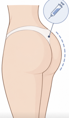 힙필러 용량, 많이 넣는다고 예뻐지는 건 아닙니다 관련 이미지 2