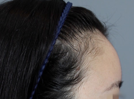 Why Results End Up Bad After Finding a ‘Hair Transplant Hotspot’ Clinic in Seoul: This Is Where It Comes Down to the Details image 12