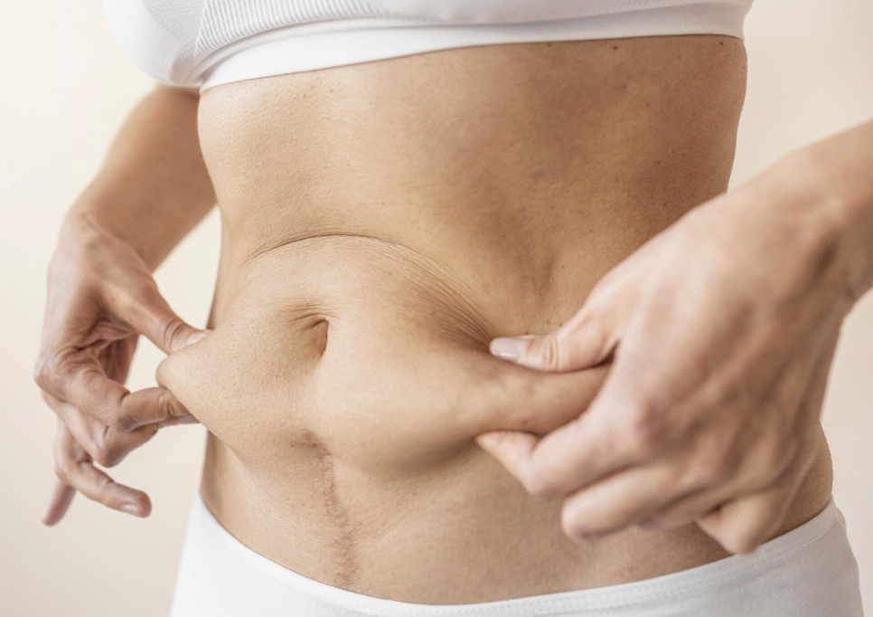 If You’re Looking for a Clinic Skilled in Revision Liposuction, Why You Should Never Simply Undergo Liposuction Again image 4
