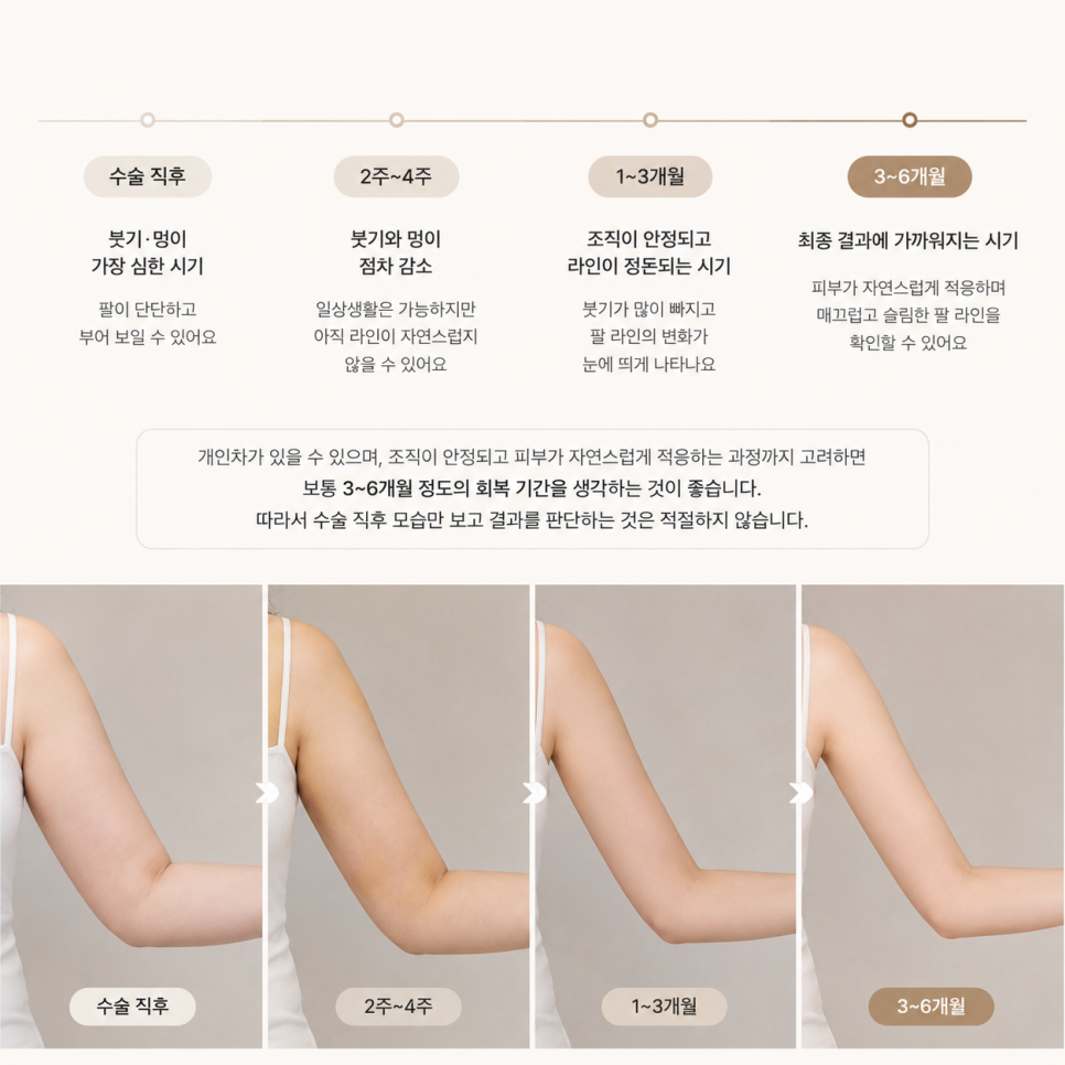 When Do the Effects of Upper-Arm Liposuction Become Visible? A Complete Guide to Swelling, Pain, and Recovery Time image 4