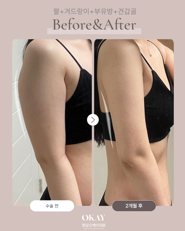 지방흡입잘하는병원 찾는다면? 부위보다 중요한 건 전체 라인 관련 이미지 5