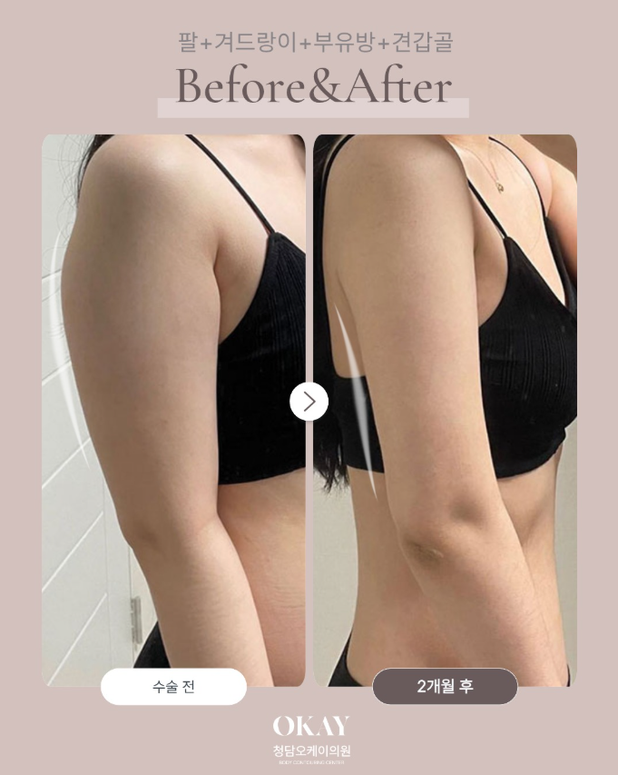 부유방제거수술, 살을 빼도 겨드랑이가 그대로라면? 관련 이미지 8