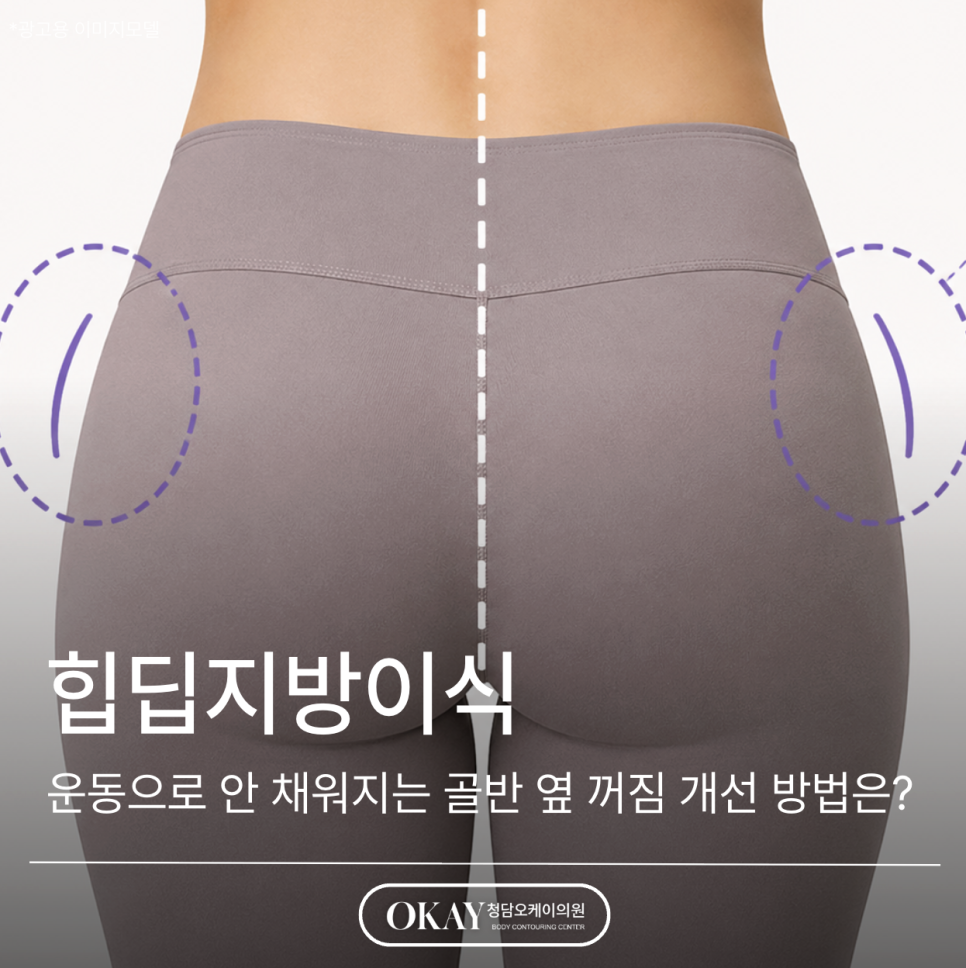 힙딥지방이식, 운동으로 안 채워지는 골반 옆 꺼짐 개선 방법은? 관련 이미지 1