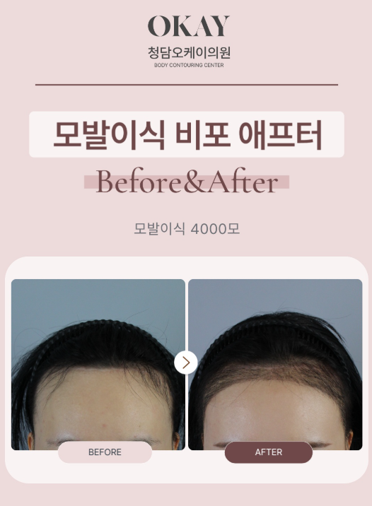 모발이식, 많이 심으면 무조건 풍성해질까요? 관련 이미지 5