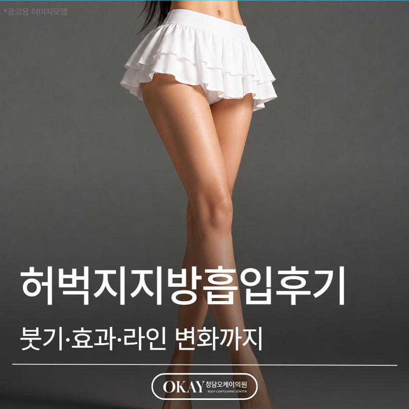 허벅지지방흡입후기, 붓기&middot;효과&middot;라인 변화까지 설명드립니다 관련 이미지 1