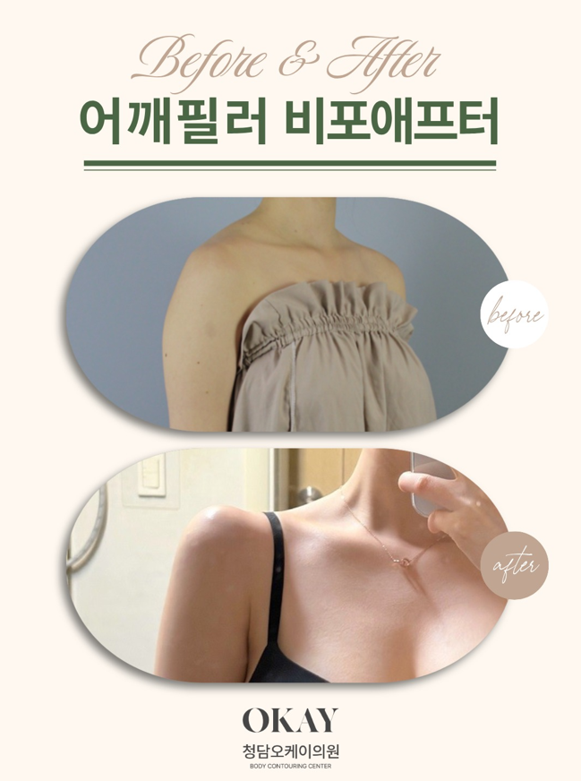 청담역성형외과 어깨필러, 어깨라인이 예뻐 보이는 사람들의 공통점 관련 이미지 9