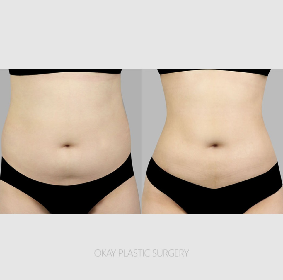 How to Lose Abdominal Fat: When Is Liposuction Needed for Belly Fat That Dieting Can't Remove? image 9