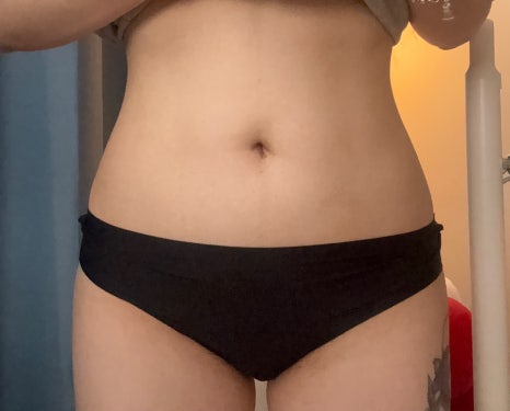 Upper Body Liposuction Pain vs Swelling: Which Is Harder? A Comparison Based on Real Experience image 7