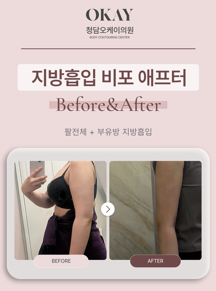 팔지방흡입, 통증은 얼마나 갈까요? 회복 과정 총정리 관련 이미지 10