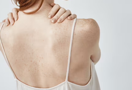 압구정 어깨필러 유지기간 얼마나 갈까? 통증&middot;붓기&middot;촉감부터 cc&middot;멍&middot;운동&middot;부작용 후기까지 관련 이미지 2