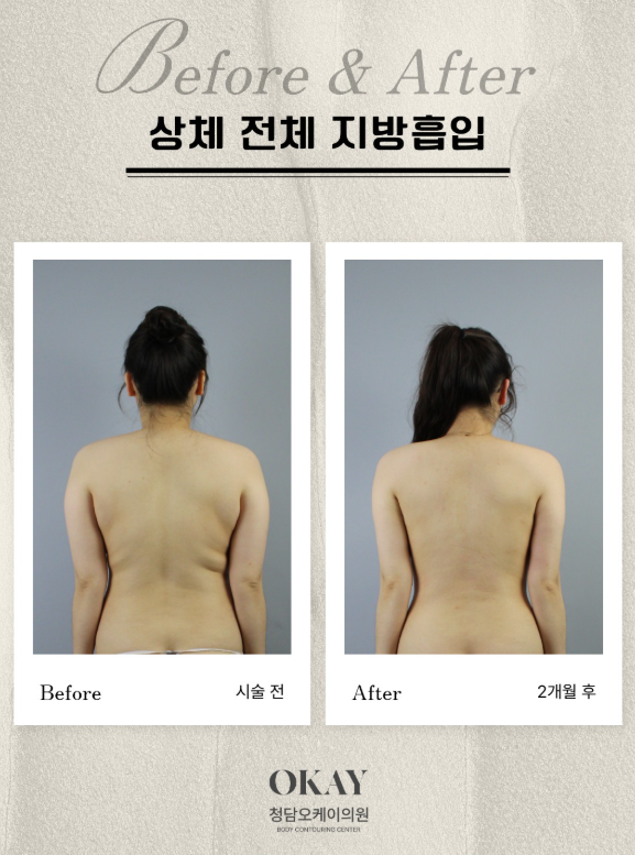 뒷구리살 지방흡입, 운동으로 안 빠질 때 고려해도 될까? 관련 이미지 9