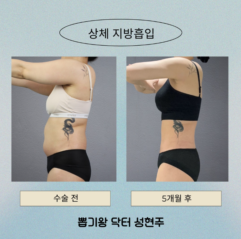 지방흡입 내돈내산, 처짐부터 멍·회복기간까지 솔직하게 알려드립니다 관련 이미지 6