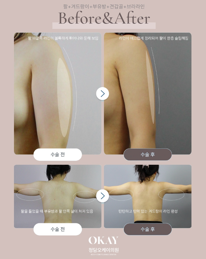 부유방지방흡입, 가격&middot;후기&middot;붓기&middot;회복기간까지 설명드립니다 관련 이미지 5