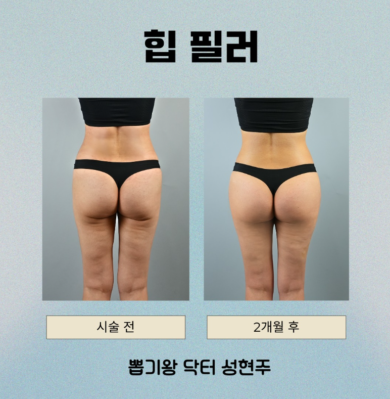 청담동 골반필러 자연스럽게 되는 기준, 과하지 않게 라인 만드는 방법 관련 이미지 4