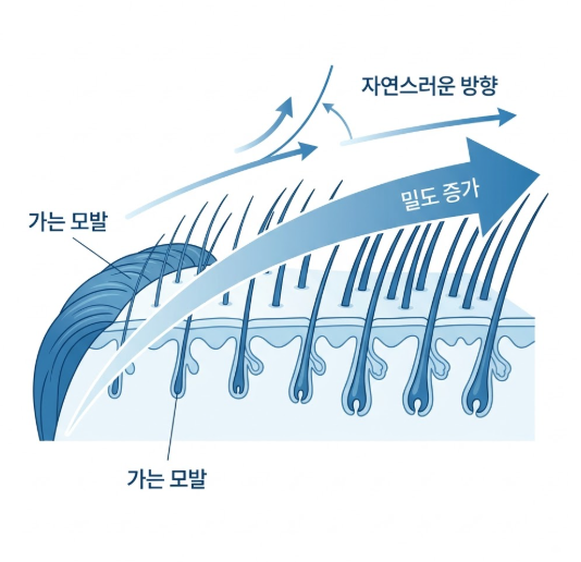 헤어라인모발이식, 이마만 채우면 끝일까요? 관련 이미지 5