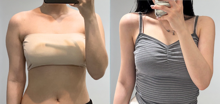 Arm Liposuction Review, How Long Do Swelling and Pain Last? Explanation of Recovery Criteria image 9