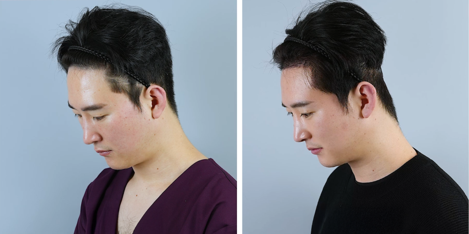 남자헤어라인모발이식, 부자연스러워 보이는 이유를 설명드립니다 관련 이미지 9