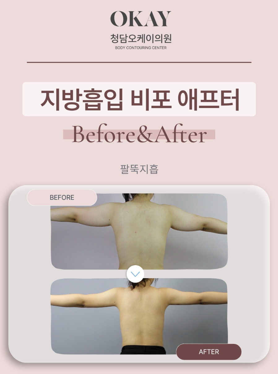 서울지방흡입, 운동해도 안 빠지는 살이라면 효과 있을까요? 관련 이미지 5