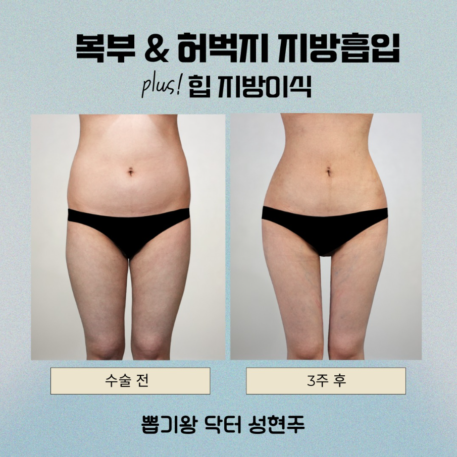 허리지방흡입 고민이라면, 운동으로 안 빠지는 옆구리 해결될까? 관련 이미지 7