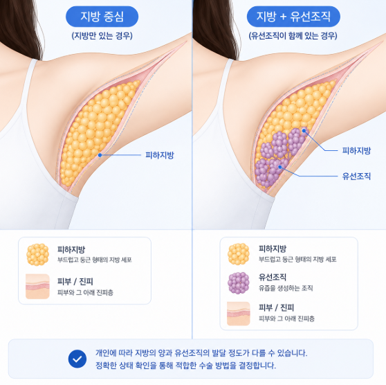 부유방수술비용, 지방흡입만 하면 더 저렴할까요? 관련 이미지 5