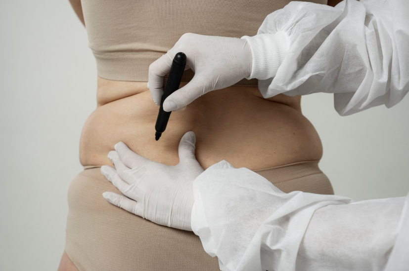 지방흡입재수술, 울퉁불퉁한 라인 다시 매끈해질 수 있을까? 관련 이미지 2