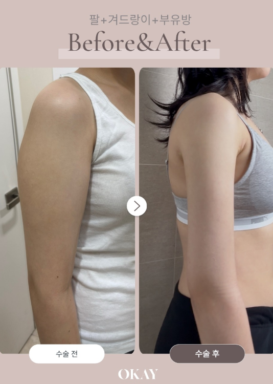 부유방지방흡입, 팔뚝살인 줄 알았는데 빠지지 않는 이유 관련 이미지 7
