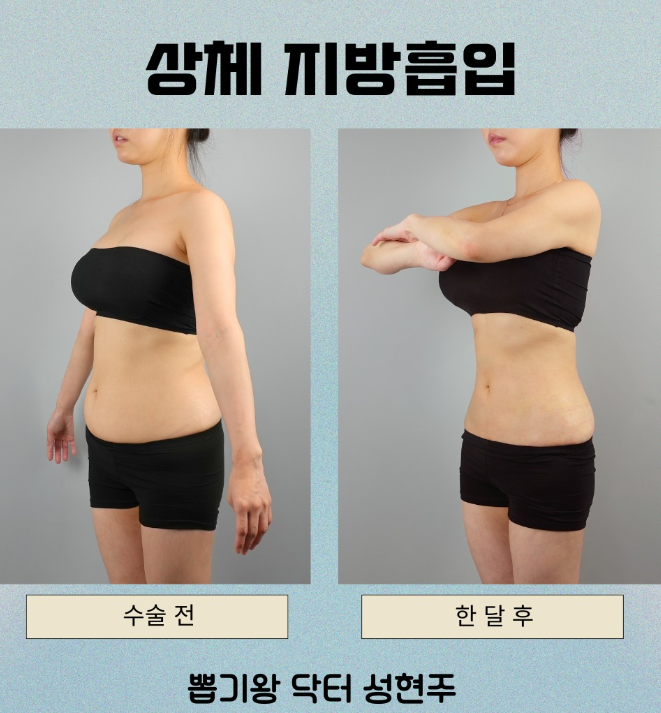 강남역지흡잘하는곳 찾기 전, 체형에 맞는 디자인이 중요한 이유 관련 이미지 9