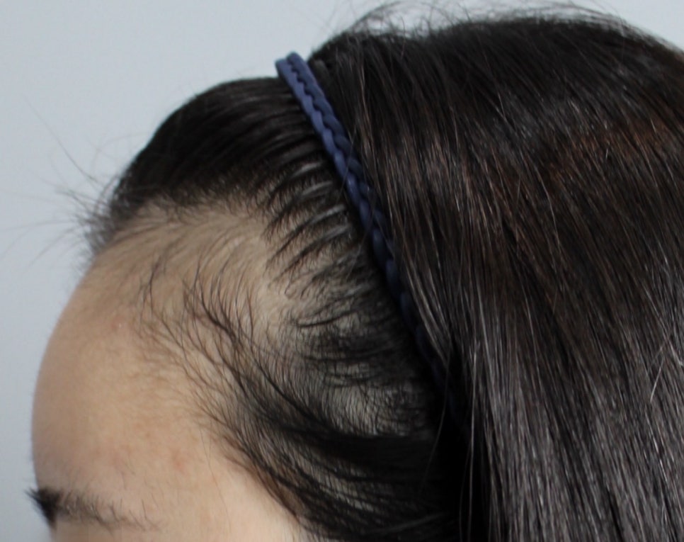 Why Are the Results of Apgujeong Female Hairline Hair Transplant Different? Differences by Type, Graft Survival Rate, and Naturalness image 3
