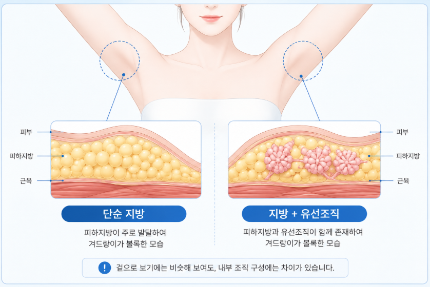 겨드랑이부유방 제거, 지방흡입으로 해결할 수 있을까요? 관련 이미지 6