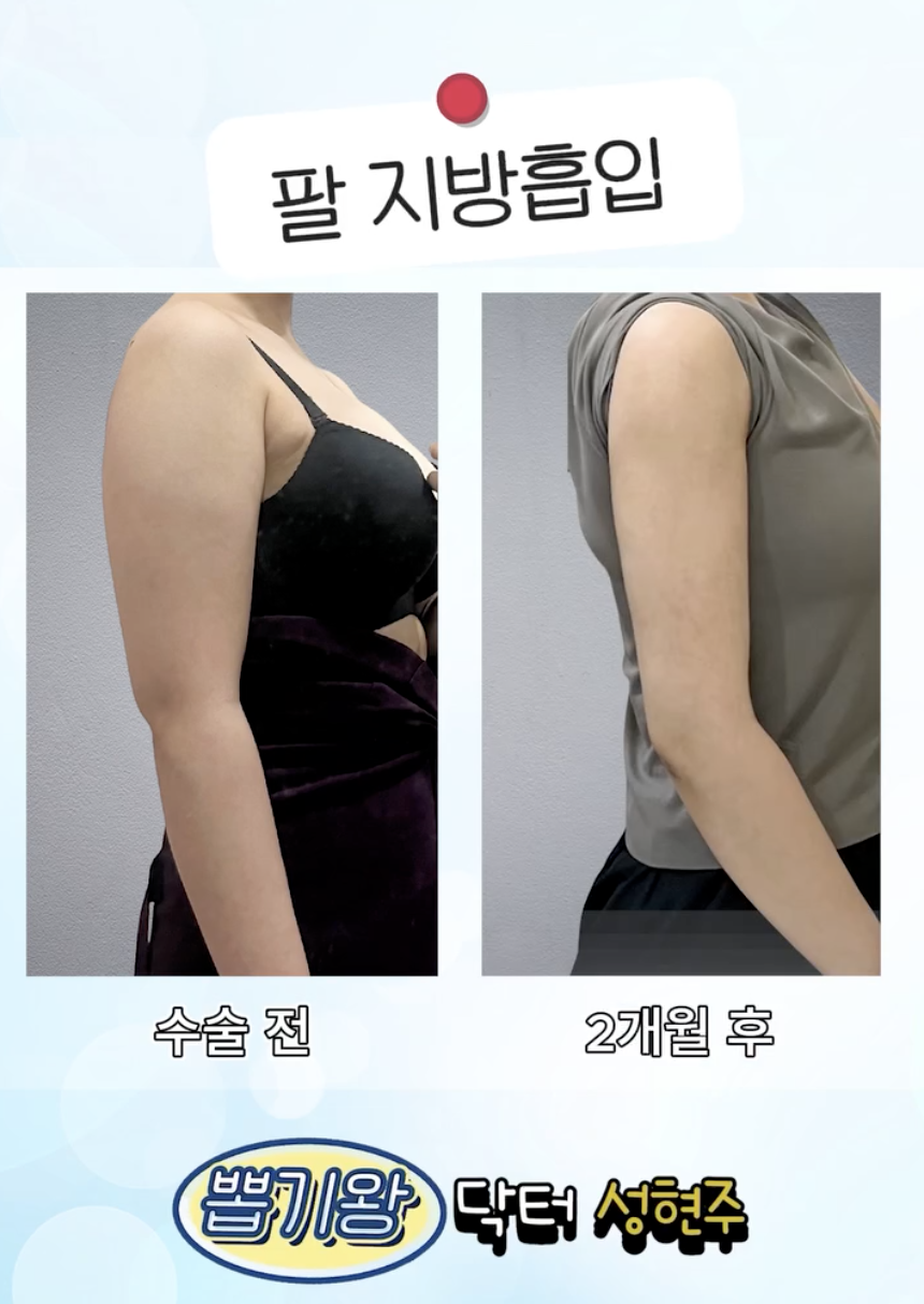 Liposuction Bio-Bond Care: First, Understand Why It Becomes Hard image 5