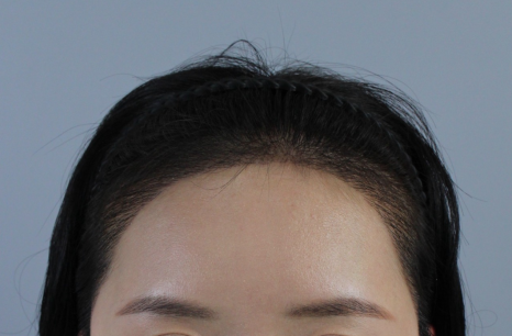Side Effects of Non-Incision Hair Transplant: A Summary of the Most Common Cases image 10