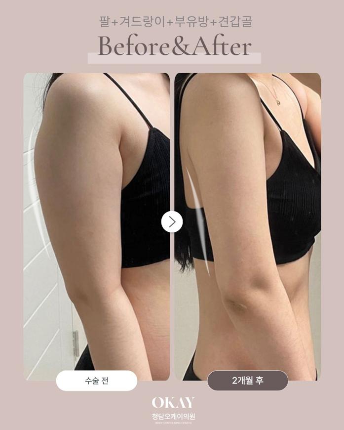 Arm Liposuction Review: A Clear Overview of the Recovery Process and Changes in Contour image 8