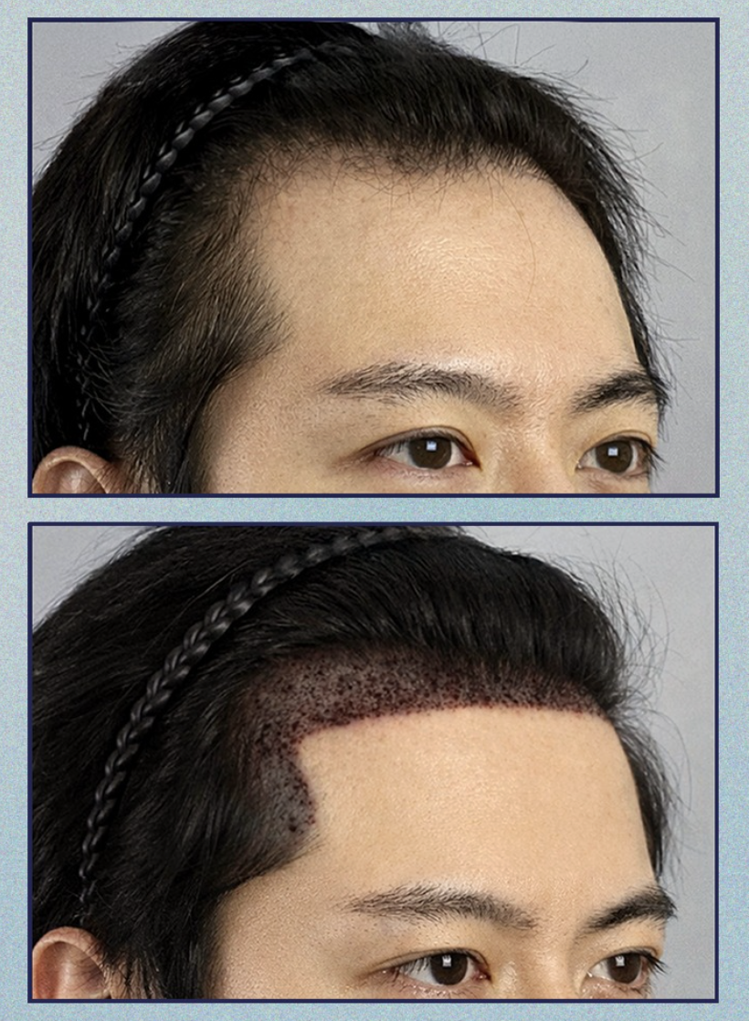 헤어라인모발이식, 실패를 줄이기 위해 꼭 확인해야 할 5가지 관련 이미지 9