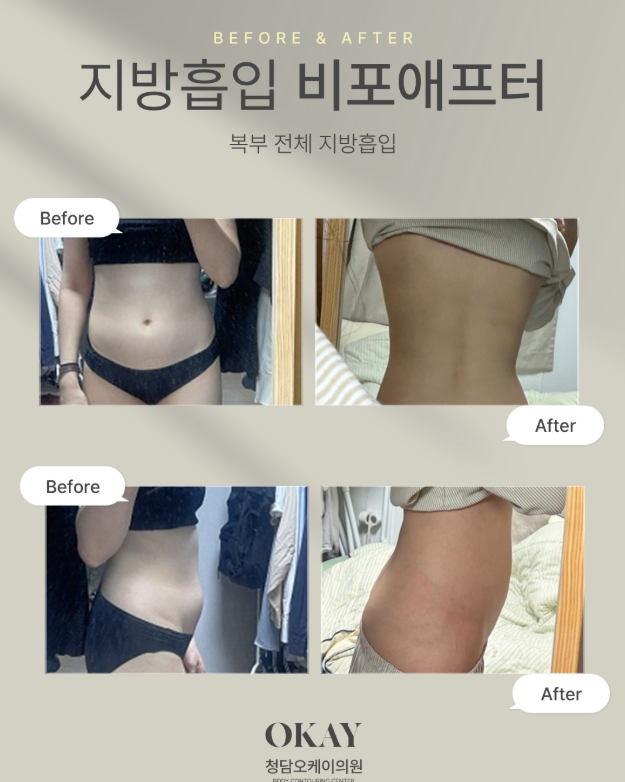 Liposuction for the Love Handles: The Decisive Difference That Defines the Waistline image 9
