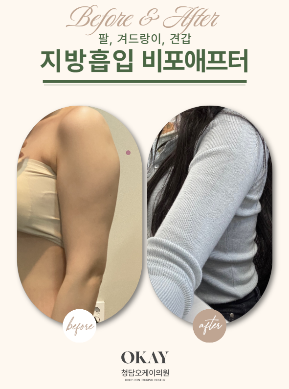 Why Is Aftercare Important After Arm Liposuction? Compression Garments, Massage, and Swelling Management Explained image 6