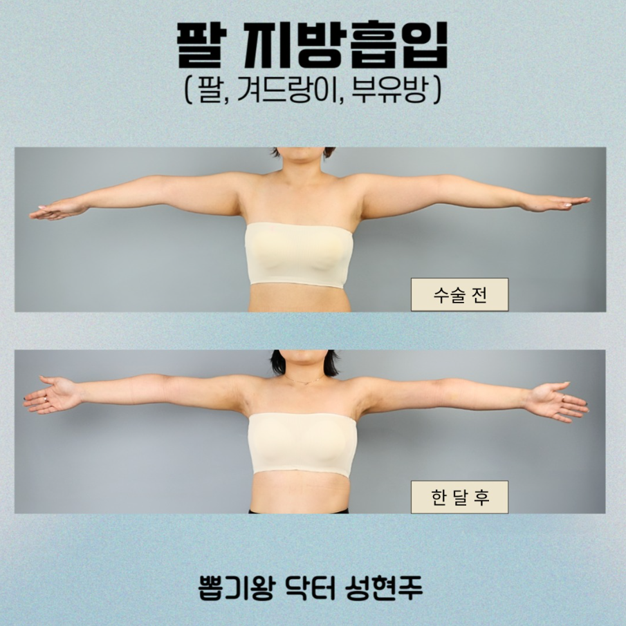 압구정 다이어트, 지방흡입 후기로 보는 부위별 라인 변화 관련 이미지 7