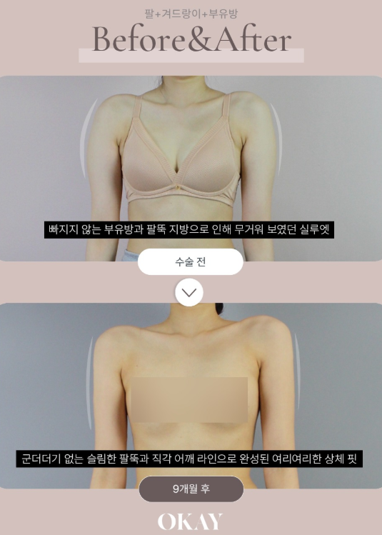 지방흡입회복기간, 일상생활은 언제부터 가능할까요? 관련 이미지 8