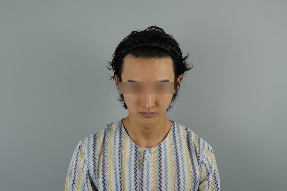 Can Hair Transplant Graft Survival Rates Differ Between Non-Excision and Excision Methods? Comparing Differences in Recovery Management image 2
