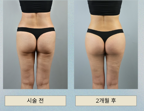 힙필러 용량, 많이 넣는다고 예뻐지는 건 아닙니다 관련 이미지 7